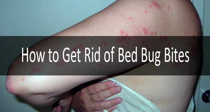 How To Get Rid Of Bed Bug Bites 