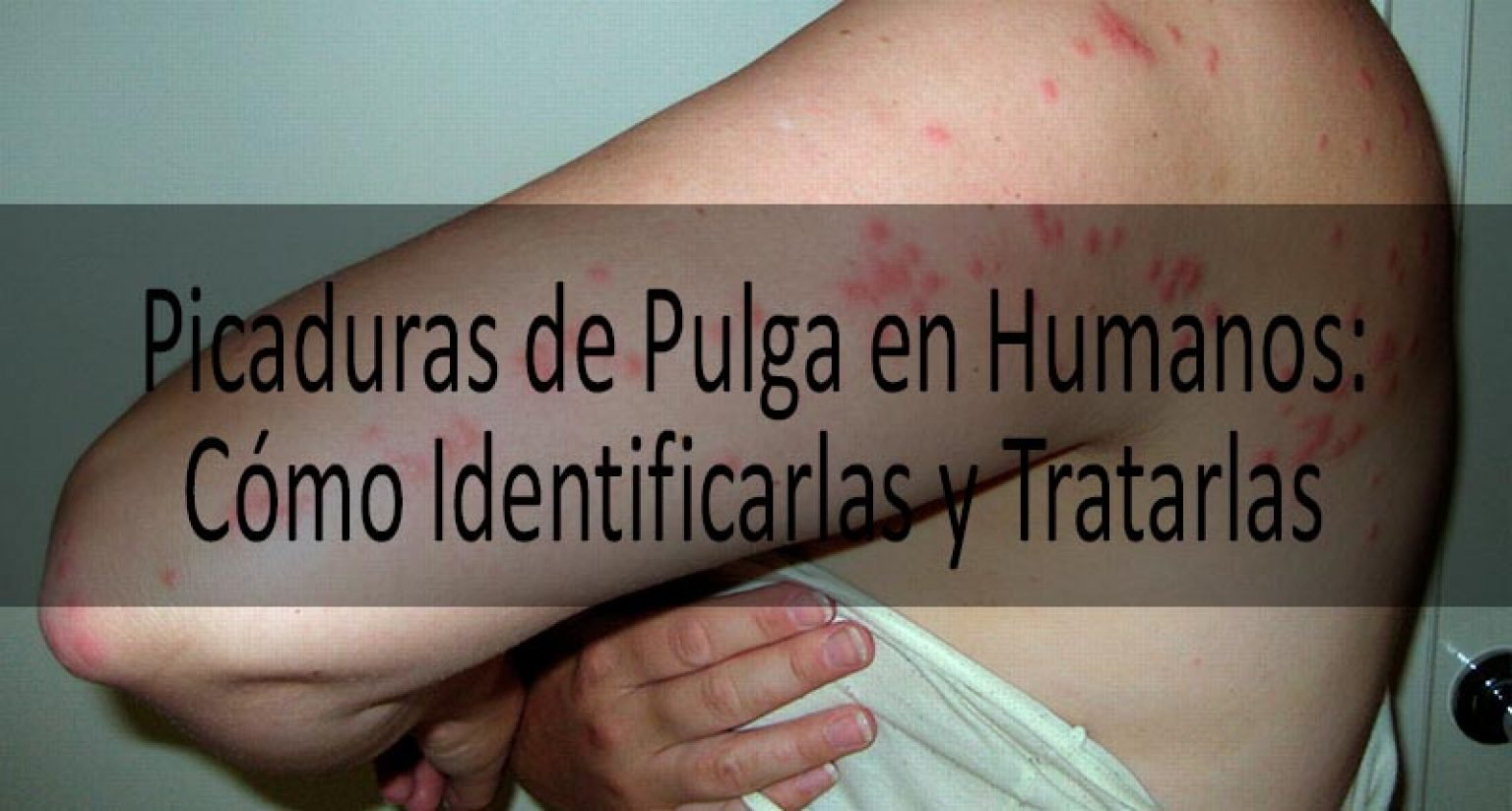 Cómo Librarse De Las Picaduras De Pulga En Humanos Picaduras De Pulga Vs Picaduras De Mosquito